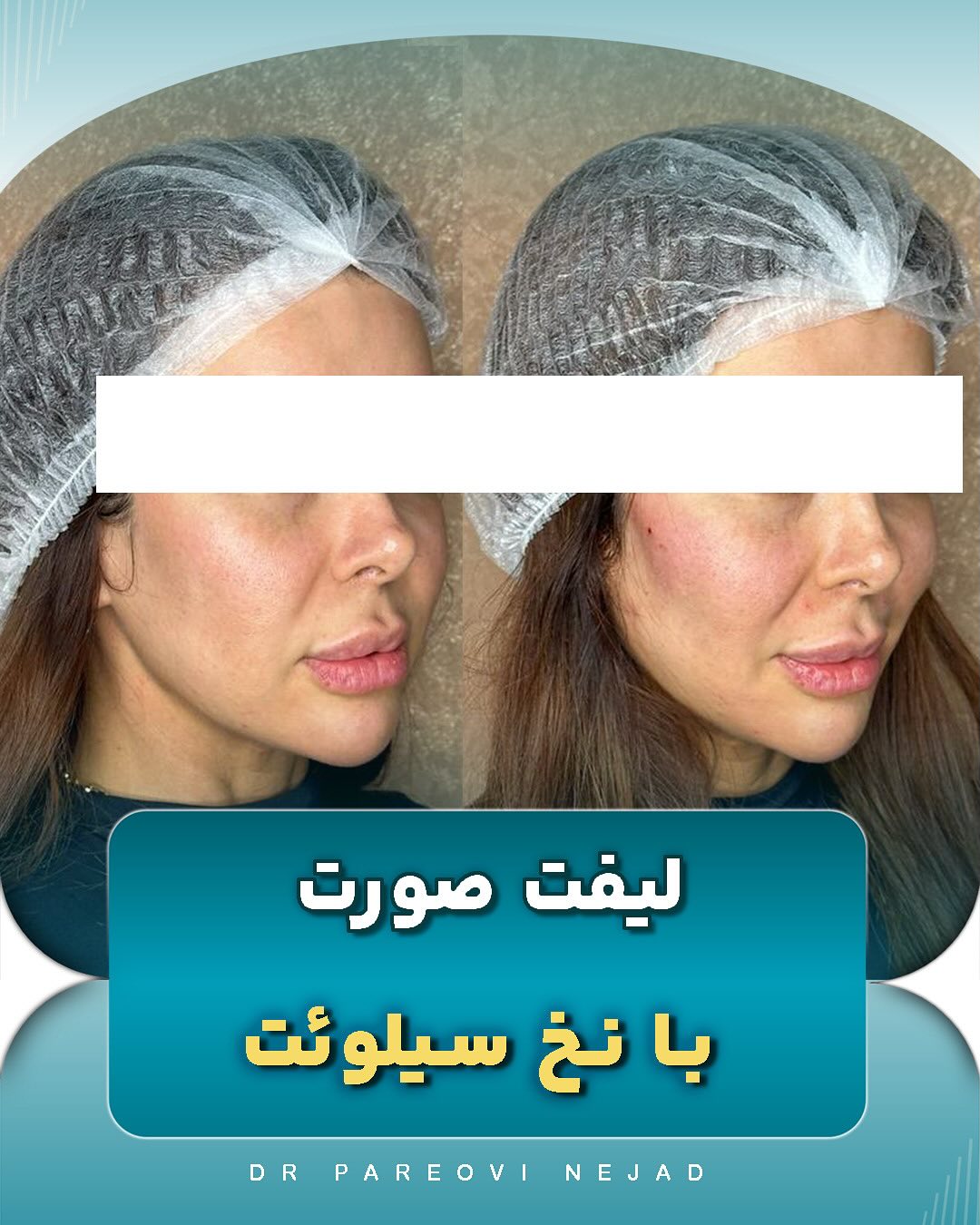 تصاویر لیفت صورت با نخ