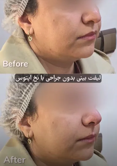 عکس لیفت بینی با نخ