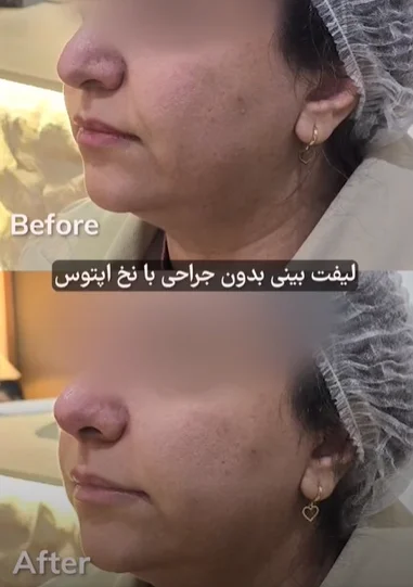 عکس لیفت بینی گوشتی با نخ