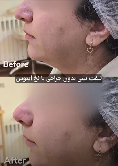 عکس قبل و بعد لیفت بینی با نخ