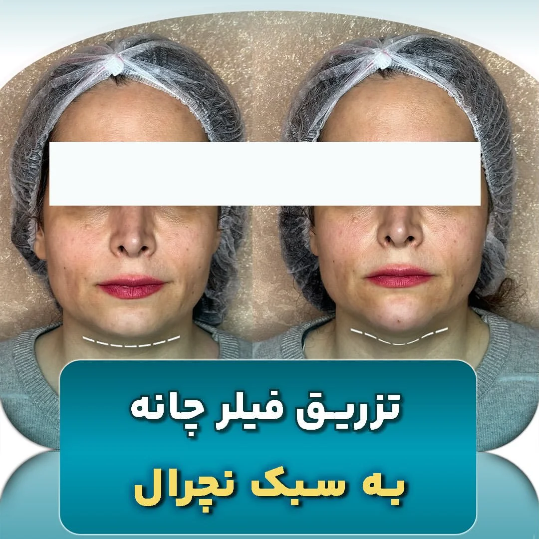 تزریق فیلر چانه به سبک نچرال توسط دکتر علی پرتوی نژاد 