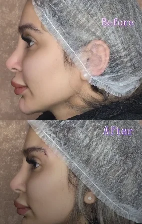 عکس لیفت ابرو با نخ