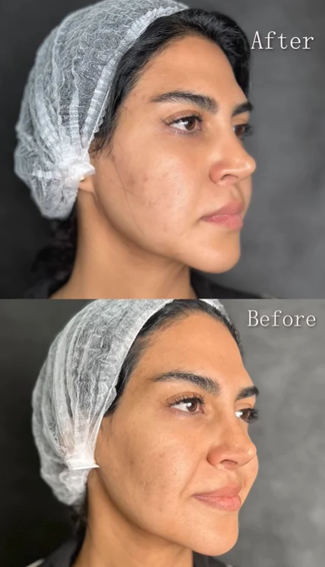 عکس قبل و بعد تزریق ژل خط خنده