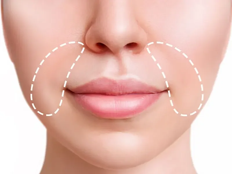 تزریق ژل خط خنده