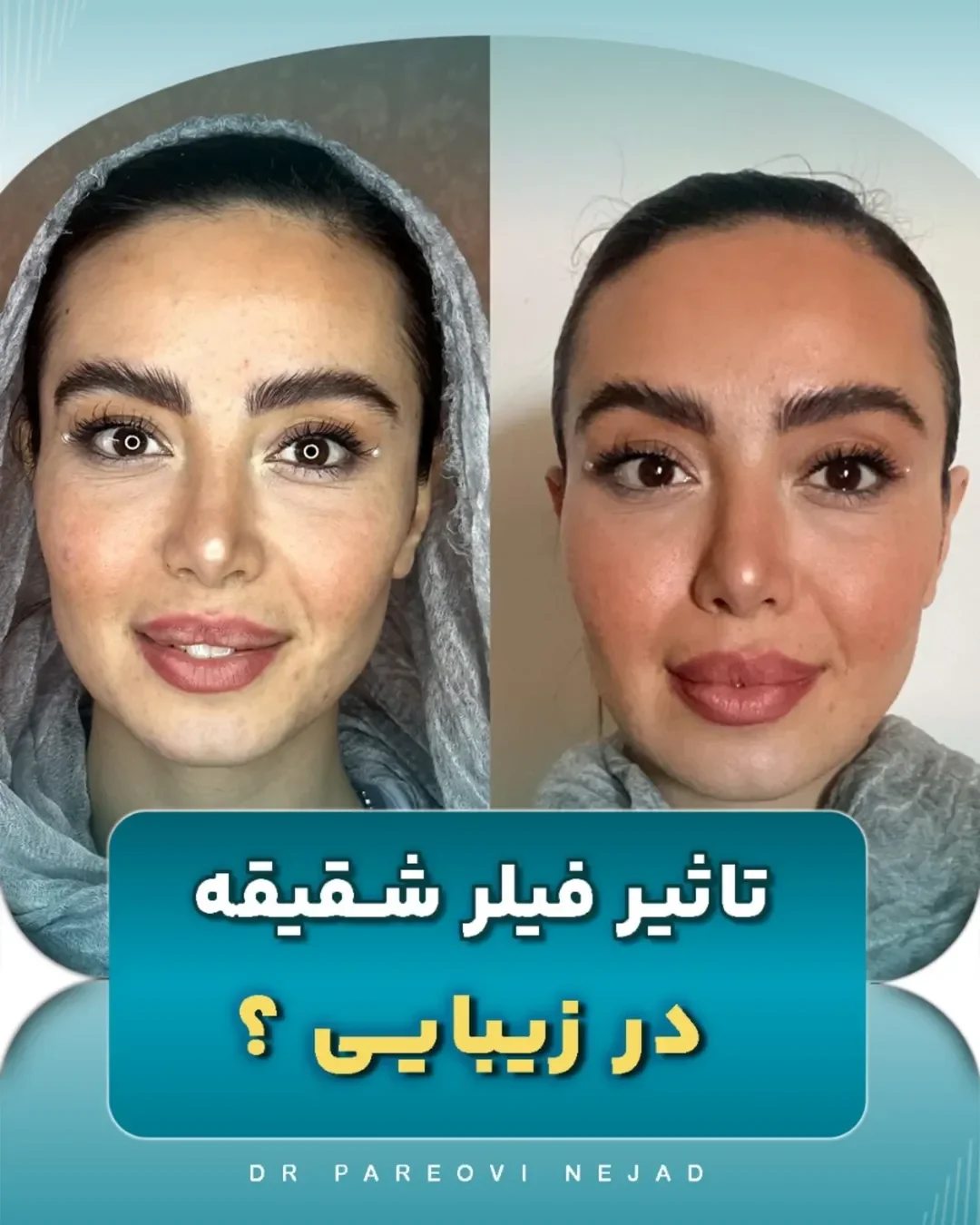 عکس لیفت شقیقه با ژل