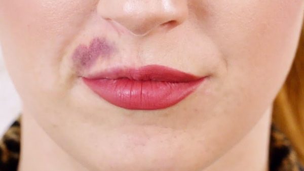 کبودی بعد از تزریق ژل