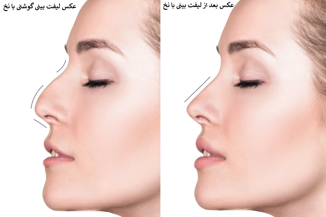 عکس لیفت بینی گوشتی با نخ