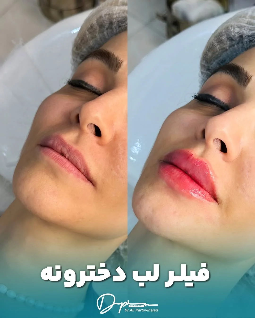 فیلر لب دخترونه