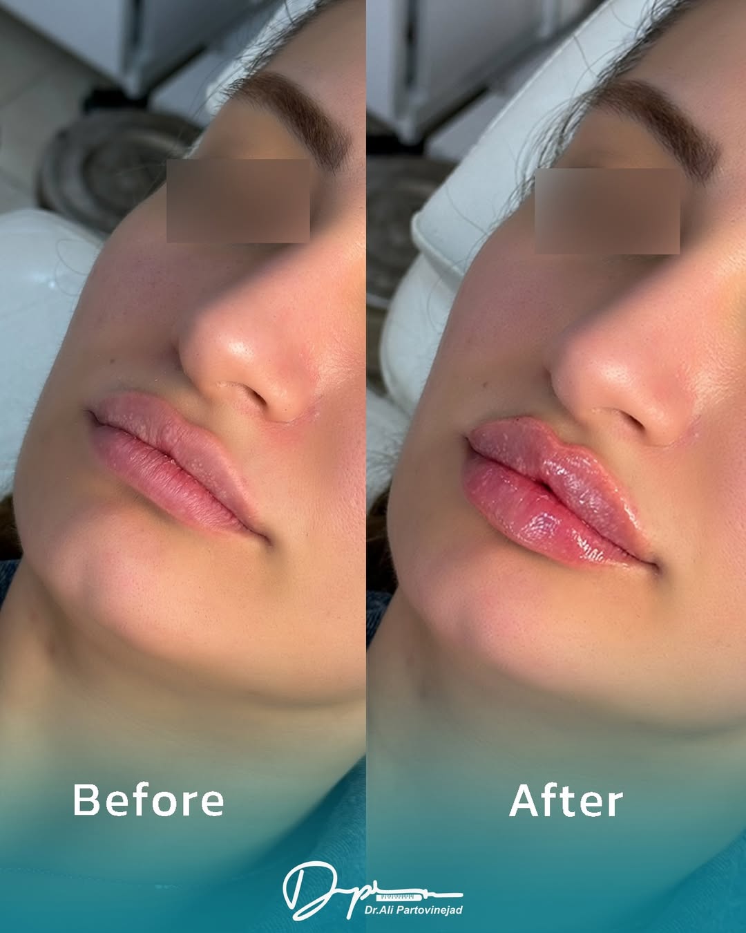 تزریق ژل لب