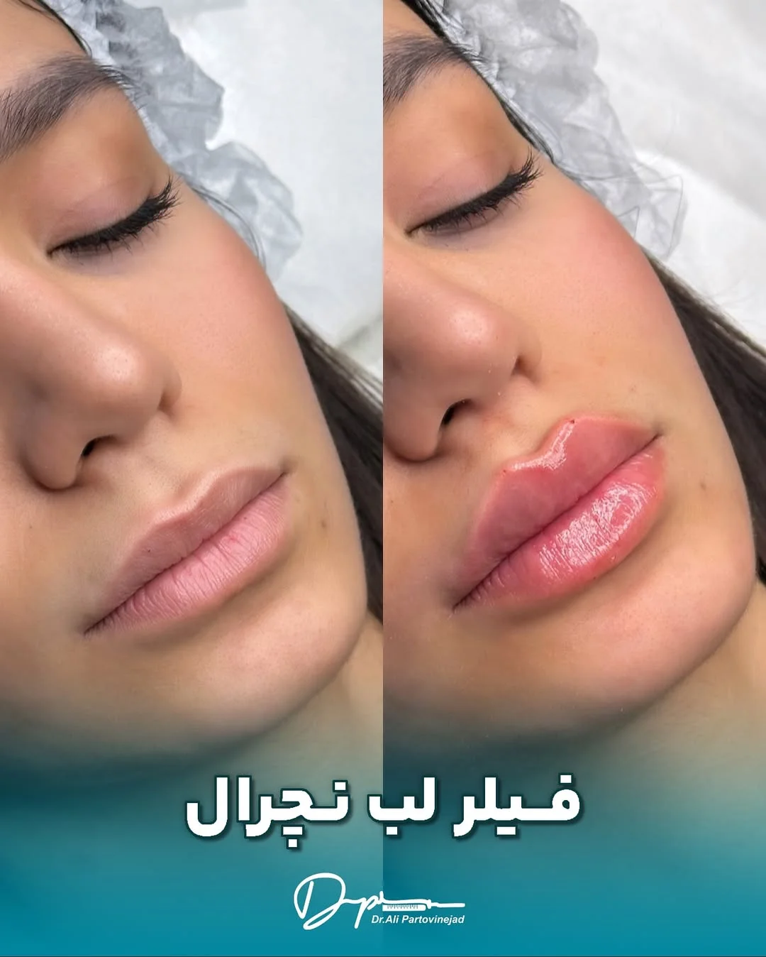 فیلر لب نچرال