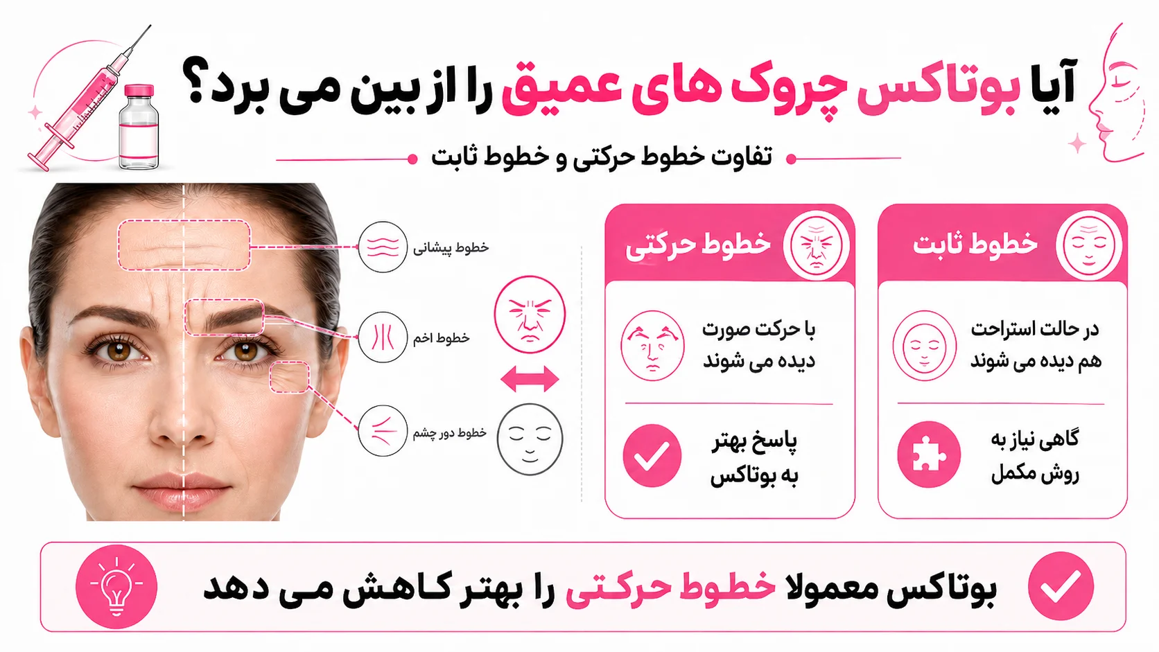 آیا بوتاکس چروک های عمیق را از بین می برد؟ تفاوت خطوط حرکتی و خطوط ثابت