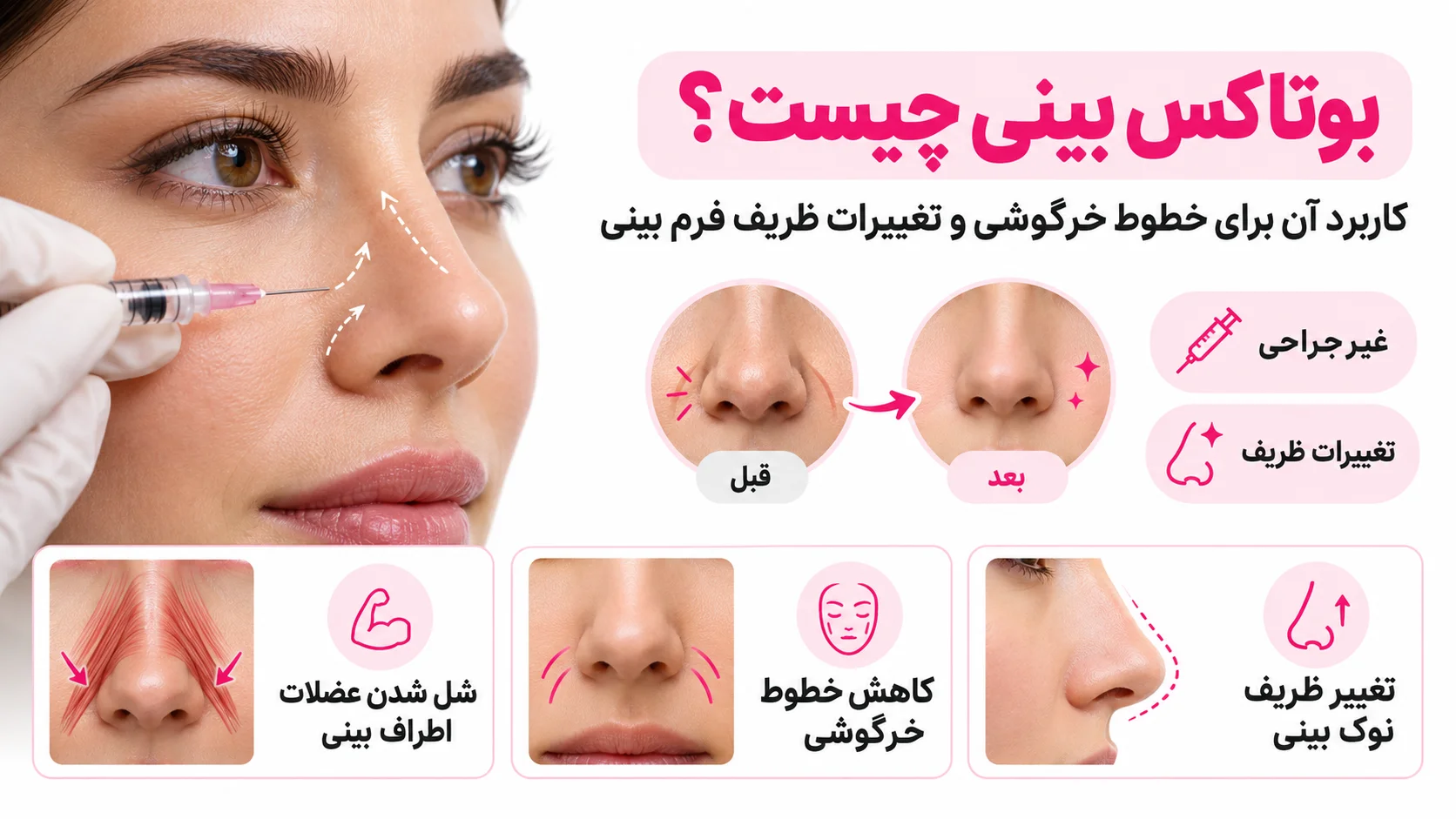 بوتاکس بینی چیست؟ کاربرد آن برای خطوط خرگوشی و تغییرات ظریف فرم بینی