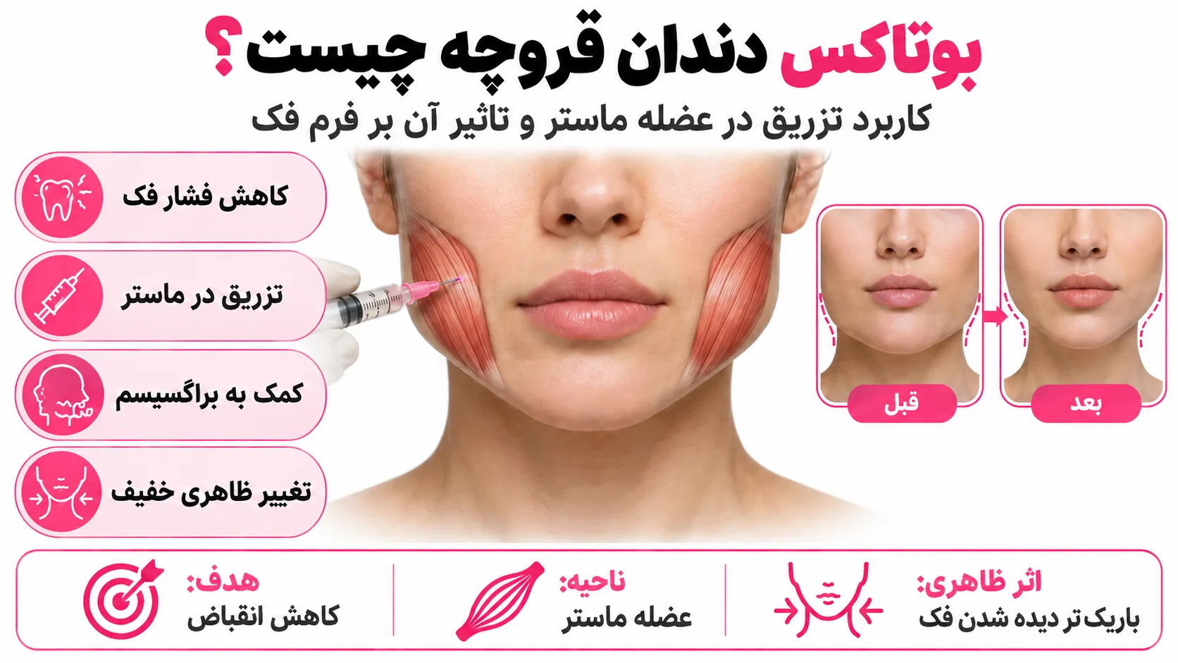 بوتاکس دندان قروچه چیست؟ کاربرد تزریق در عضله ماستر و تأثیر آن بر فرم فک