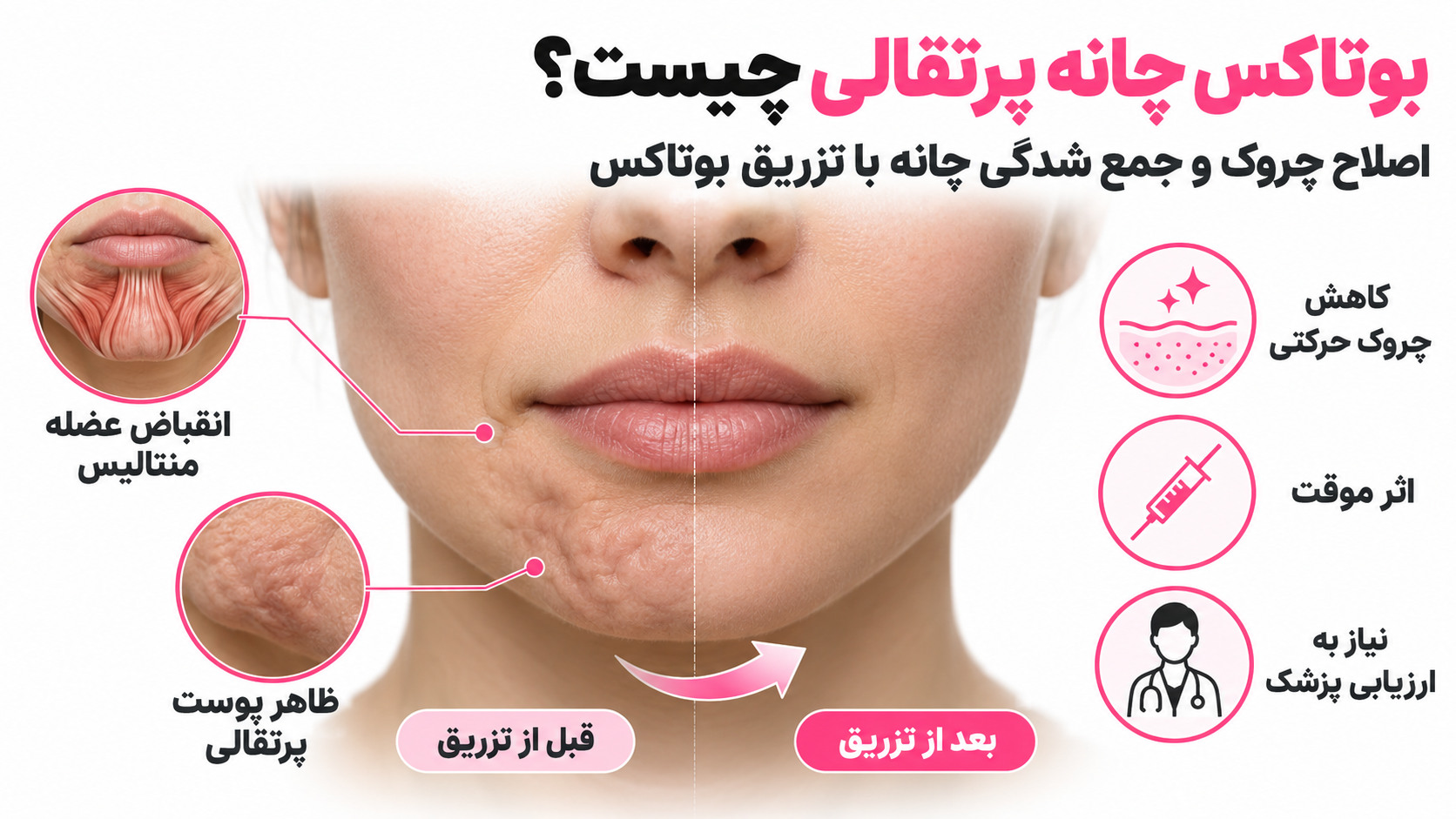 بوتاکس چانه پرتقالی چیست؟ اصلاح چروک و جمعشدگی چانه با تزریق بوتاکس