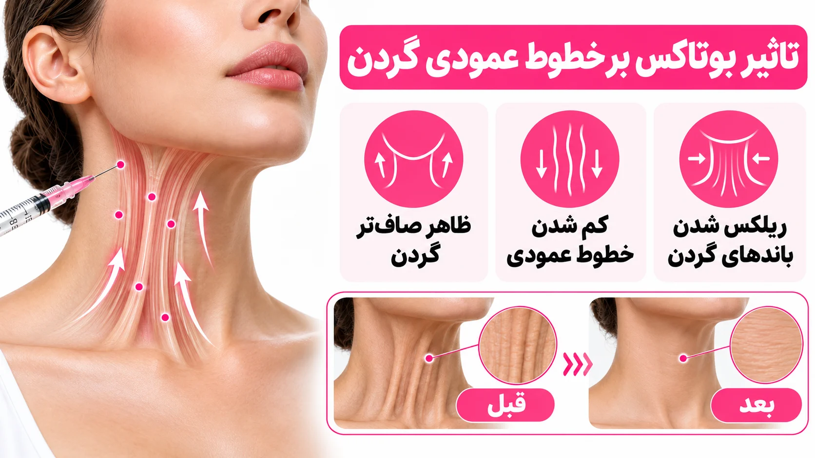 تاثیر بوتاکس بر خطوط عمودی گردن