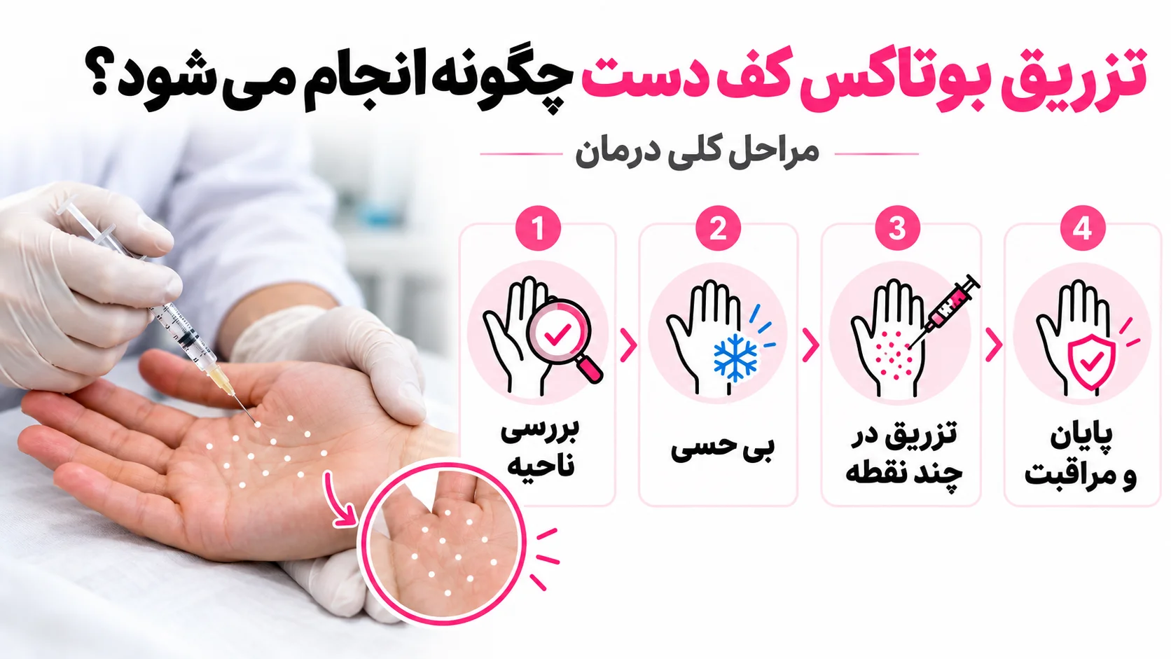 تزریق بوتاکس کف دست چگونه انجام می شود؟