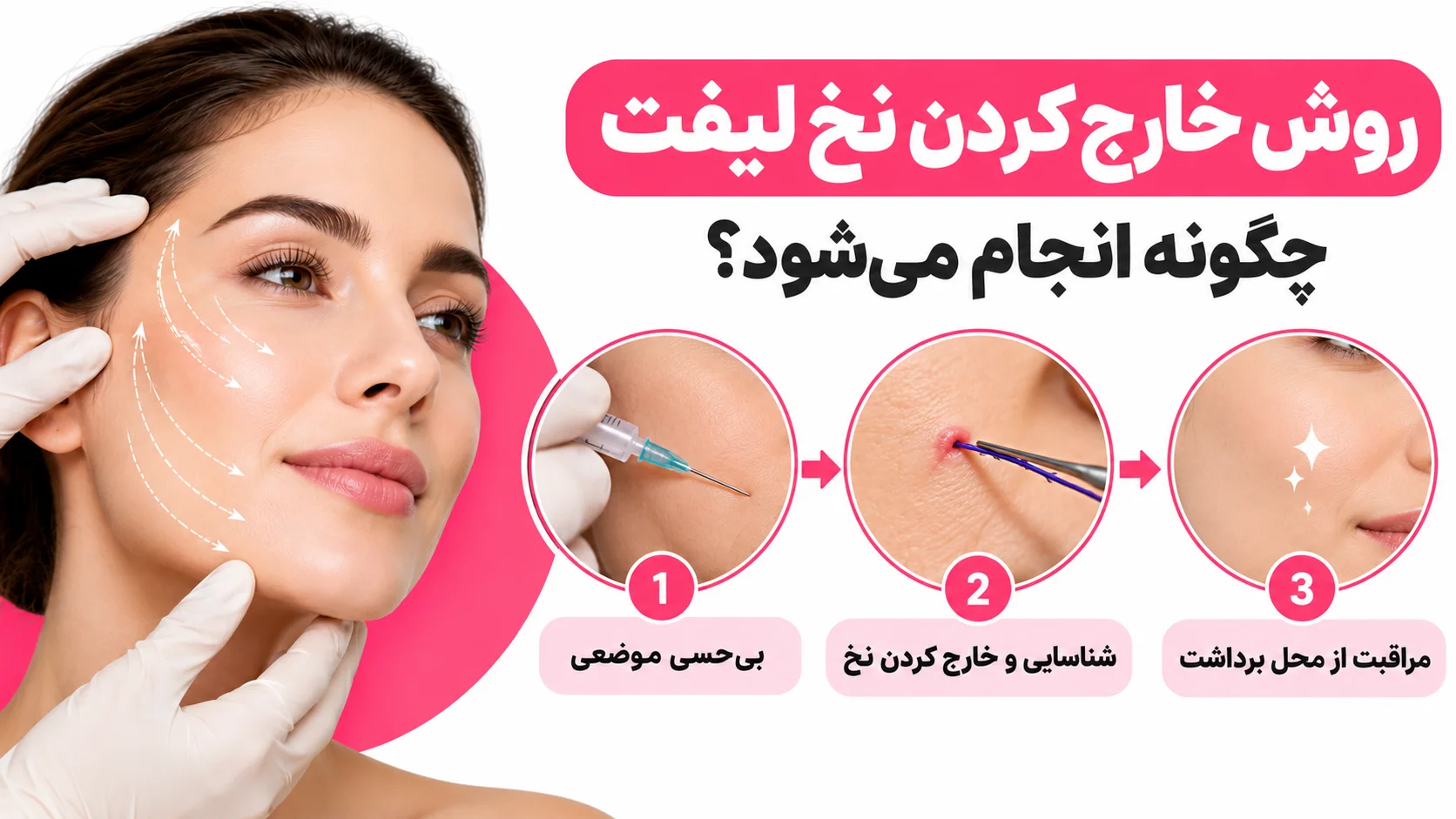 روش خارج کردن نخ لیفت چگونه است؟