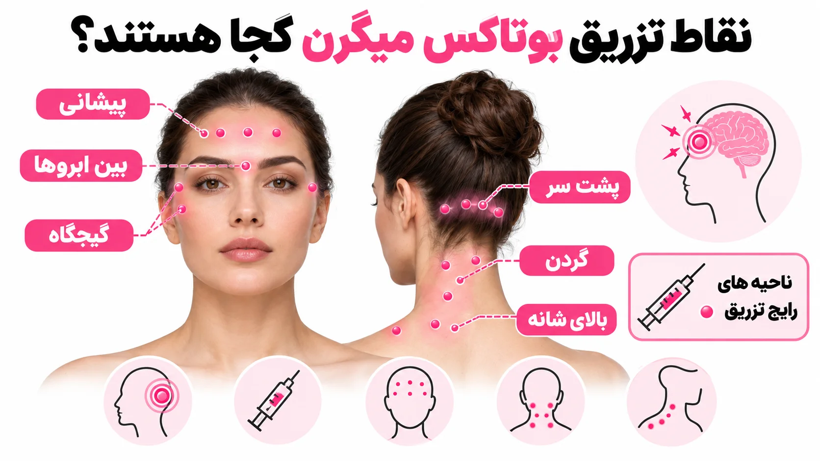 نقاط تزریق بوتاکس میگرن کجا هستند؟