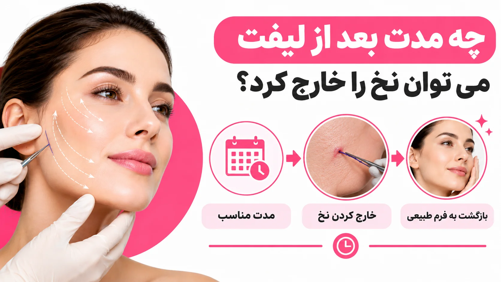 چه مدت بعد از لیفت می توان نخ را خارج کرد؟